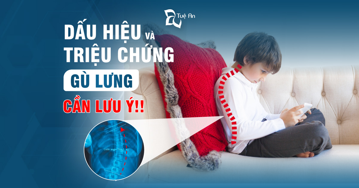 Dấu hiệu và triệu chứng gù lưng ở trẻ cần lưu ý