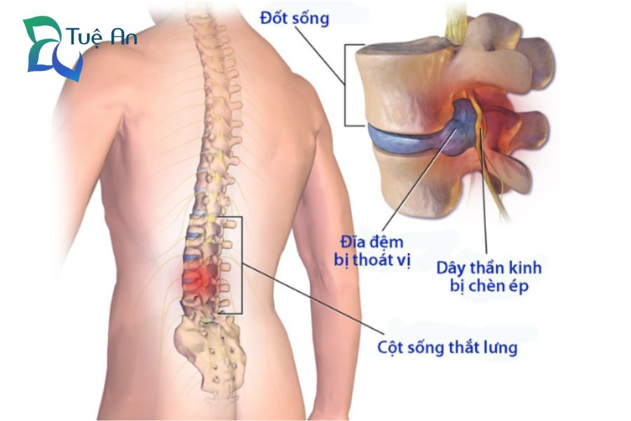 thoái hóa cột sống thắt lưng là gì