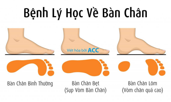 Bàn chân bẹt
