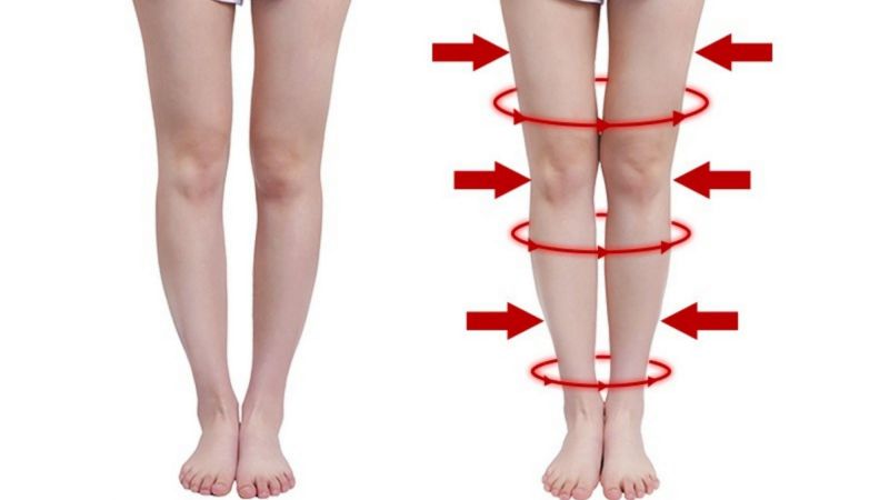 chân vòng kiềng là gì