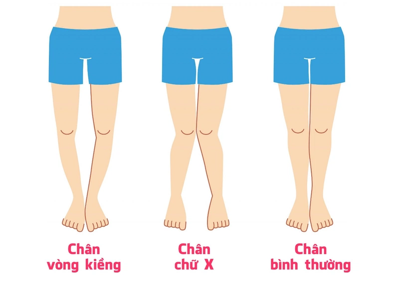 hội chứng chân vòng kiềng