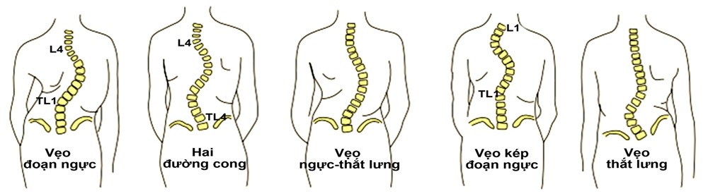 nguyên nhân gây cong vẹo cột sống