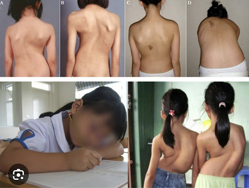 cong vẹo cột sống là gì