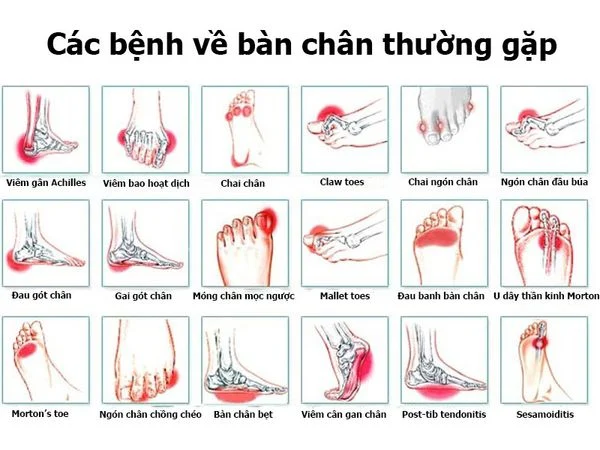 Đau bàn chân