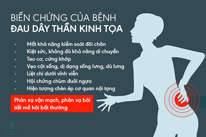 triệu chứng đau thần kinh tọa