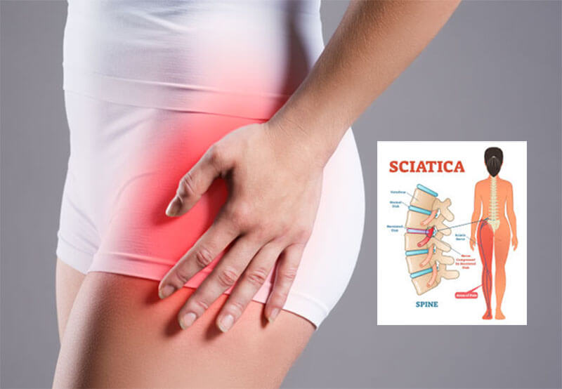 Đau thần kinh toạ lan xuống chân