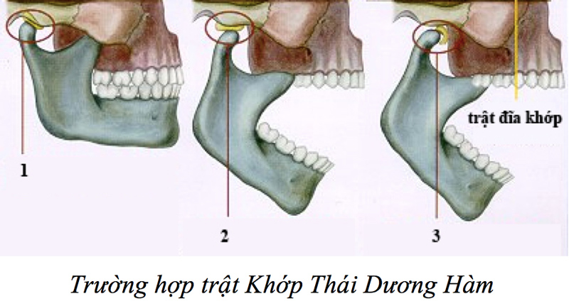 Rối loạn khớp thái dương hàm