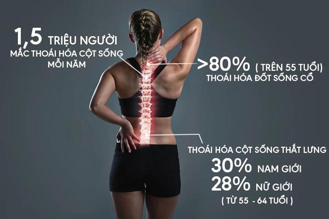thoái hoát cột sống thắt lưng